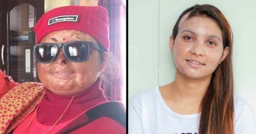 एसिडपीडित दुईजनालाई आयल निगममा एक वर्षका लागि रोजगारी