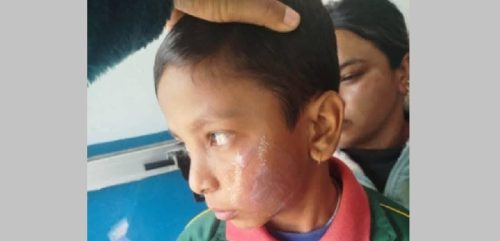पन्यूले विद्यार्थीको गाला डाम्ने शिक्षिका पक्राउ